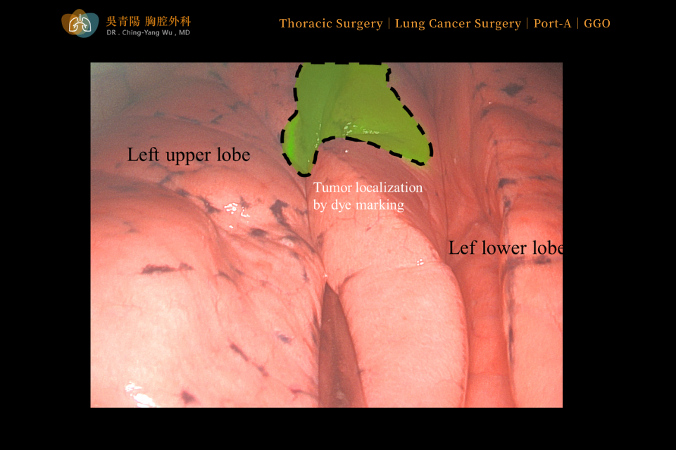 To ensure precise localization, a small amount of gas was injected to verify the dye placement adjacent to the tumor, thereby completing the localization step.