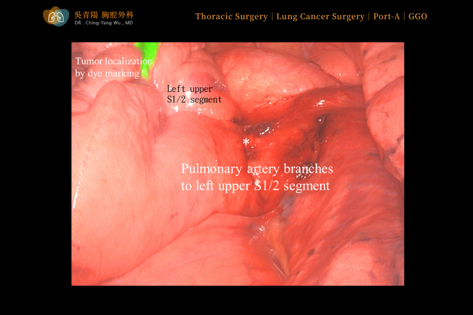 Before the lung cancer surgery started, the stained tumor area was observed in the left upper lobe, with a well-developed fissure in that region.