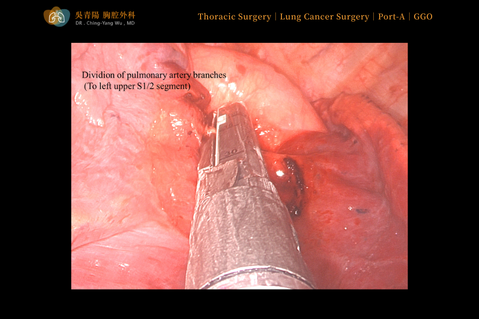 Before the lung cancer surgery started, the stained tumor area was observed in the left upper lobe, with a well-developed fissure in that region.