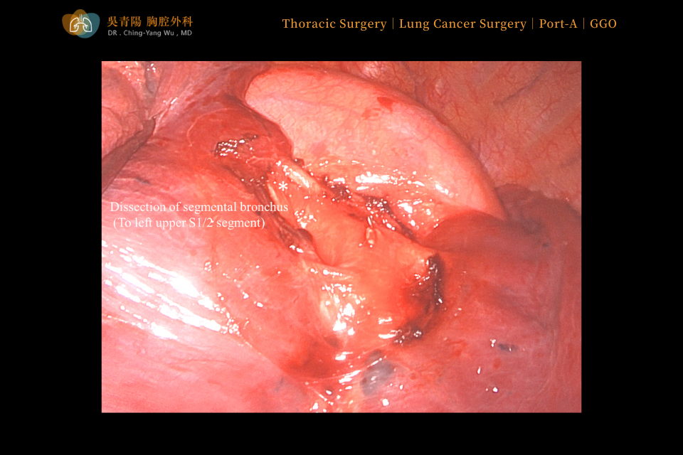 These vessels were subsequently sealed and divided with an automatic stapler.