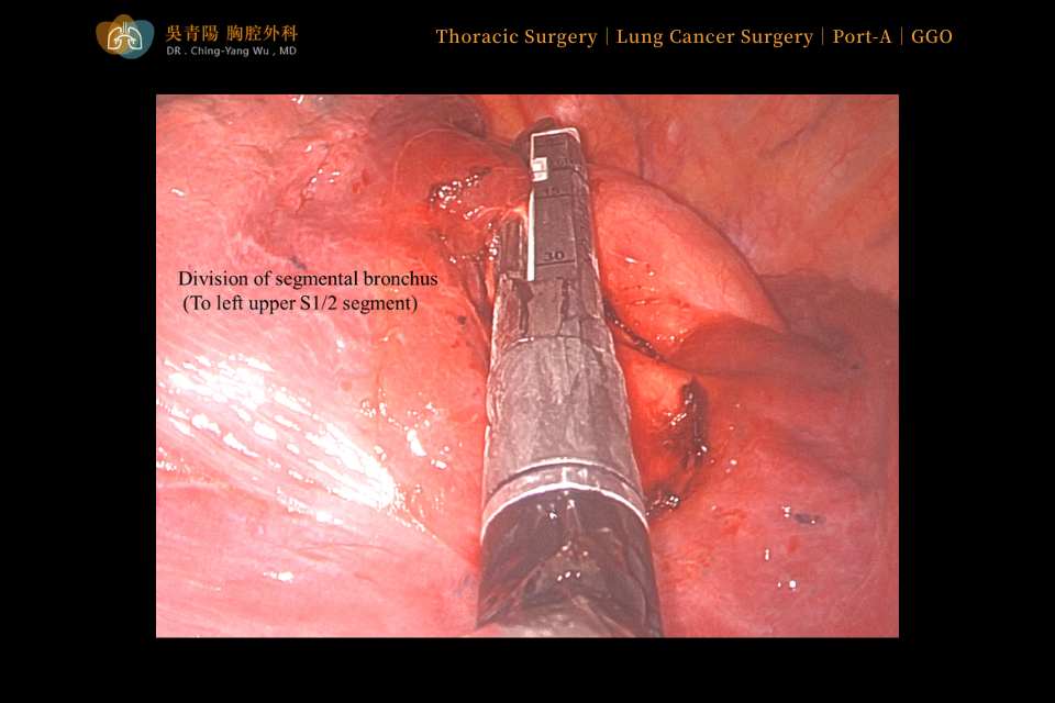 These vessels were subsequently sealed and divided with an automatic stapler.