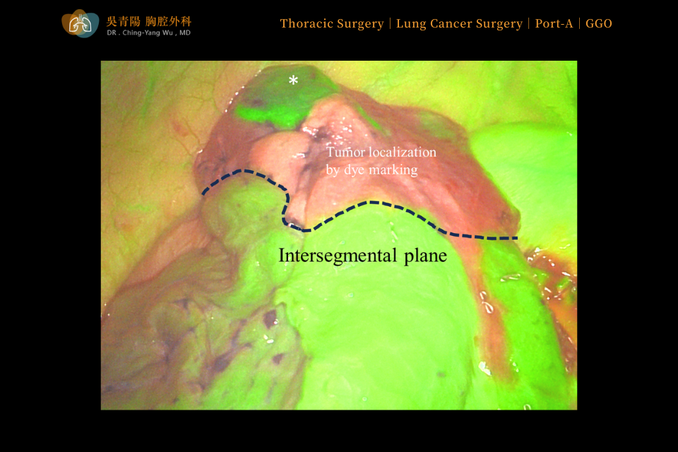 Once the pulmonary arteries had been cut and the resection area confirmed, fluorescent dye was injected at the planned boundary to clearly mark the surgical margin.