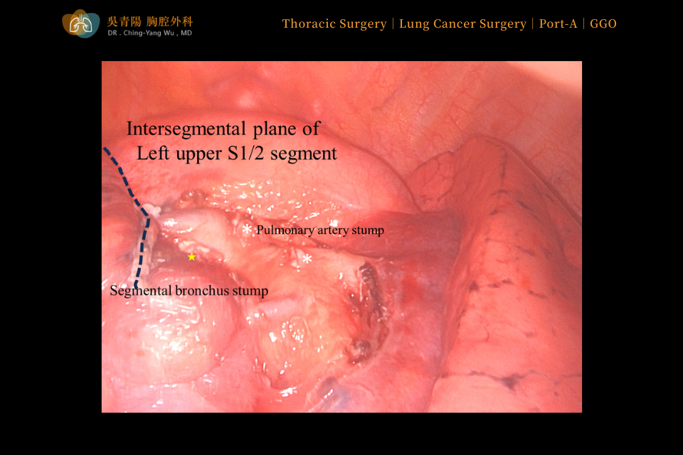 This confirmed that a safe distance was maintained between the tumor dye-marked site and the planned surgical resection margin.
