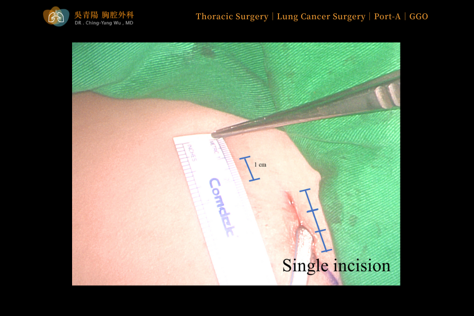 This lung cancer surgery can be completed through a single incision measuring around 3 cm, making it a minimally invasive procedure.