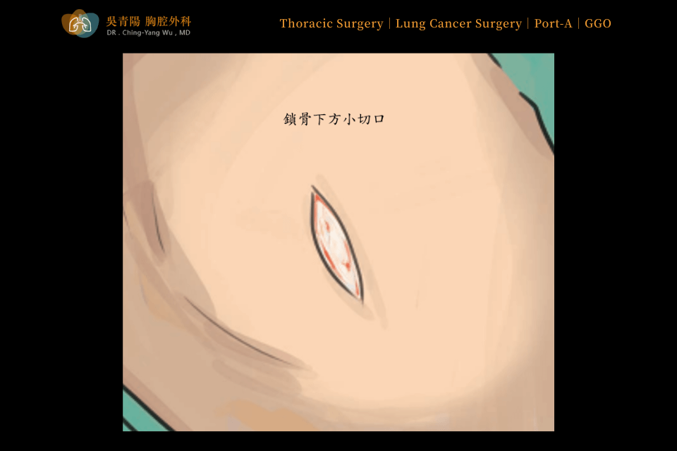 Placement Procedure of an Implantable Venous Access Port (Port-A)：Skin Incision and Tissue Dissection
