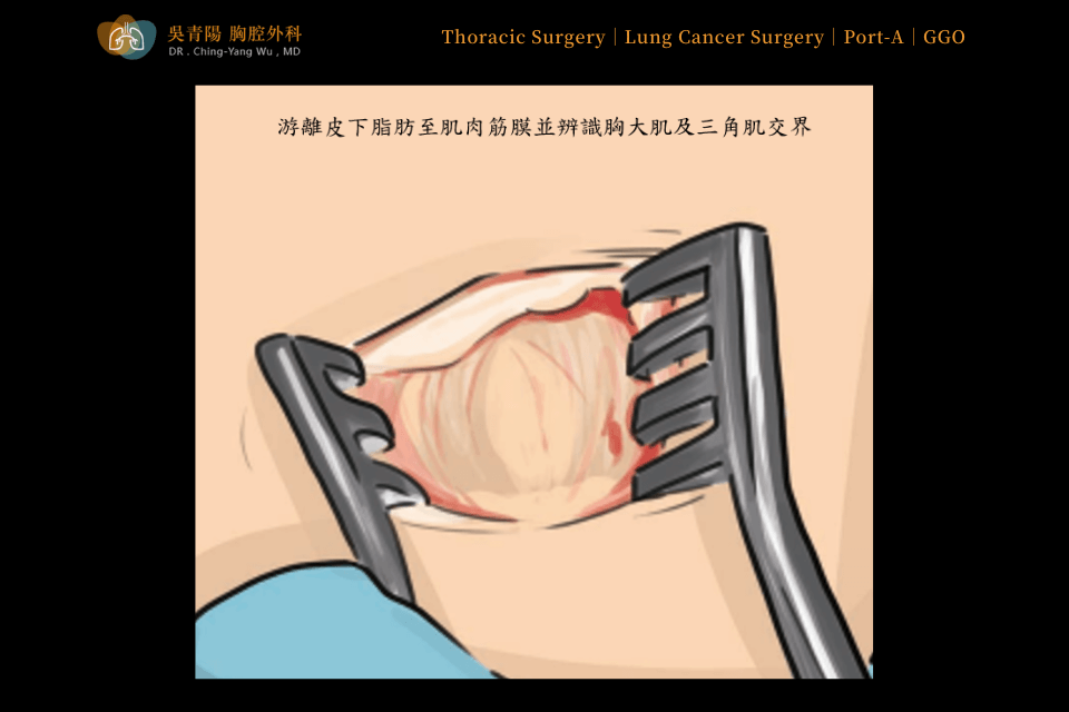 Placement Procedure of an Implantable Venous Access Port (Port-A)：Venous Exploration and Catheter Insertion