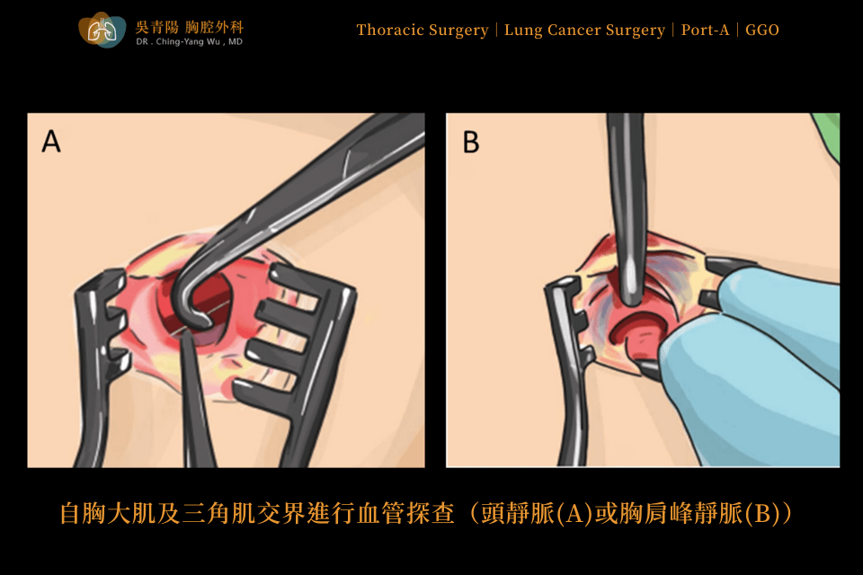 Placement Procedure of an Implantable Venous Access Port (Port-A)：Venous Exploration and Catheter Insertion