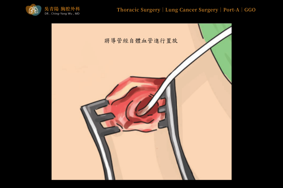 Placement Procedure of an Implantable Venous Access Port (Port-A)：Connection of the Catheter to the Port Chamber