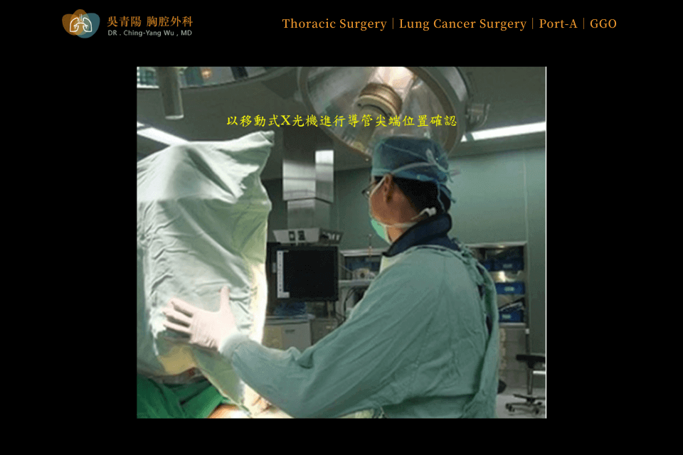 Placement Procedure of an Implantable Venous Access Port (Port-A)：Connection of the Catheter to the Port Chamber