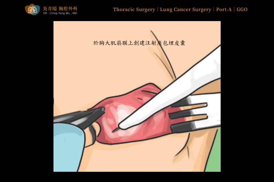 Placement Procedure of an Implantable Venous Access Port (Port-A)：Creation of a Subcutaneous Pocket