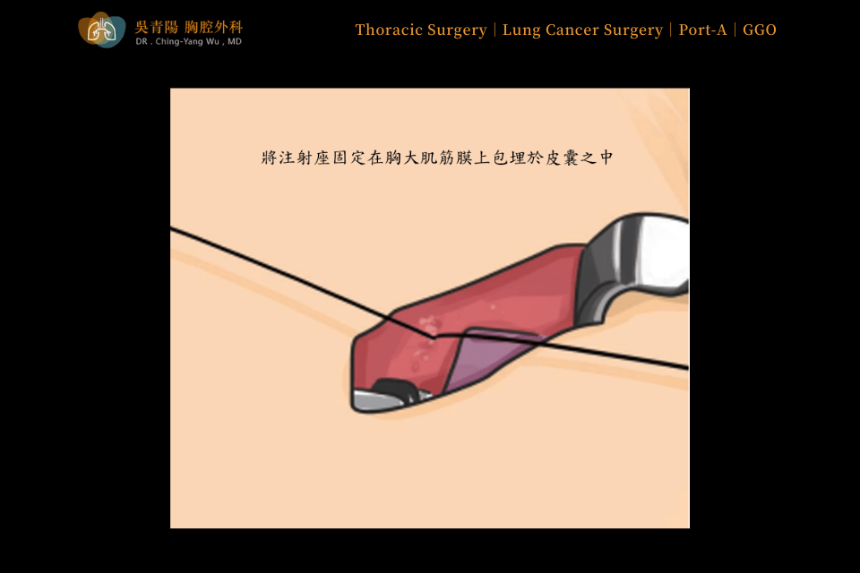 Placement Procedure of an Implantable Venous Access Port (Port-A)：Securing the Port-A Device
