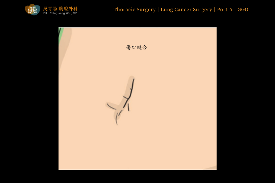 Placement Procedure of an Implantable Venous Access Port (Port-A)：Local Anesthesia