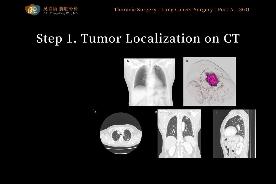 Step 1 of lung tumor surgery: marking the tumor location on CT images
