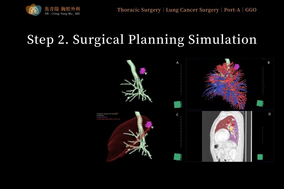 Step 2 of lung tumor surgery: simulating the resection plan and mapping lung anatomy