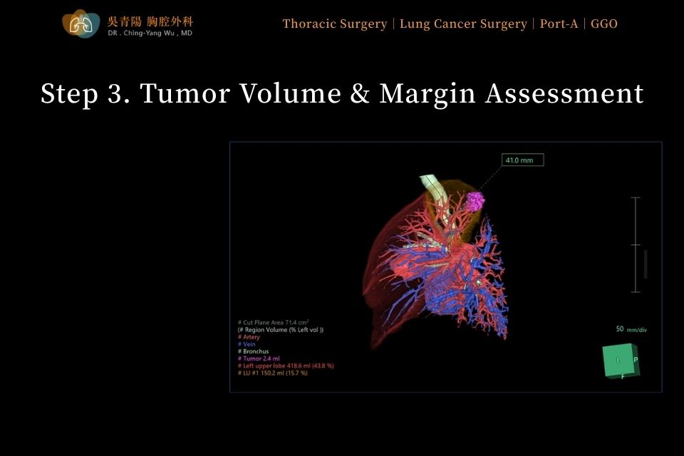 Step 3 of lung tumor surgery: assessing lung tumor volume and resection margins