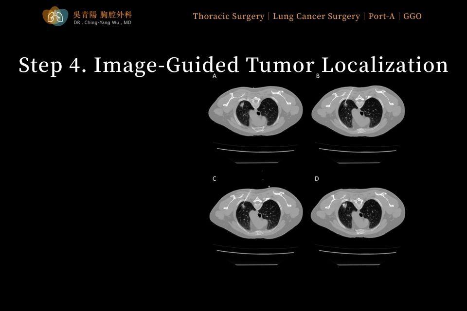 Step 4 of lung tumor surgery: image-guided localization of the lung tumor before resection