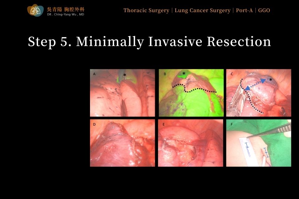 Step 5 of lung tumor surgery: minimally invasive surgical resection of the lung tumor